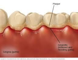 Gingivitis y su progreso en forma lineal