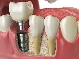 Implantologia y medicina periodontal