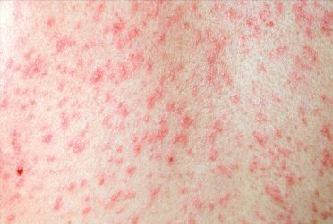 Primeros casos de sarampión en España