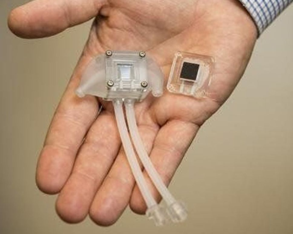 Se utiliza por primera vez un riñón artificial para la diálisis