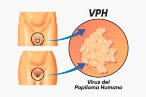 Avance científico: Eliminación del VPH.