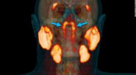 Timeline: New glands