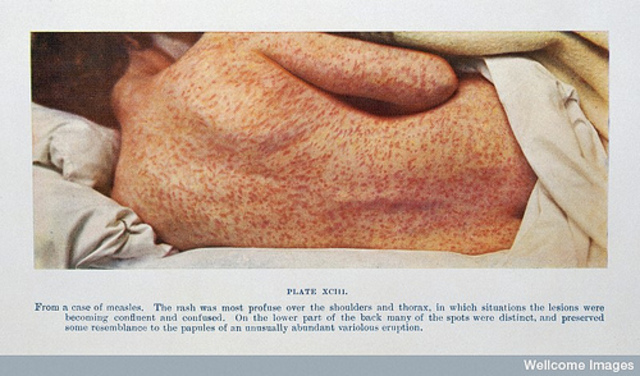 Ada caught the measles and is not able to leave her bed.