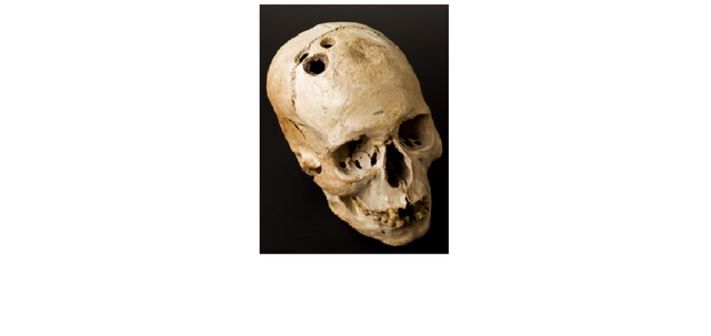 Signs of Rudimentary Surgery