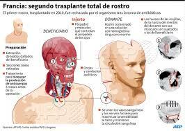 Transplant de cara