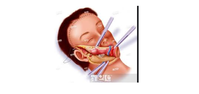 Near-Total Full Face Transplant