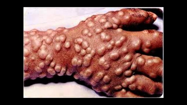 May 1796 Edward Jenner (Merrill, 2021):.........................Merrill, R. (2021). Introduction to Epidemiology. Epidemiology of Cowpox and Smallpox, Jones et Bartlett Learning.