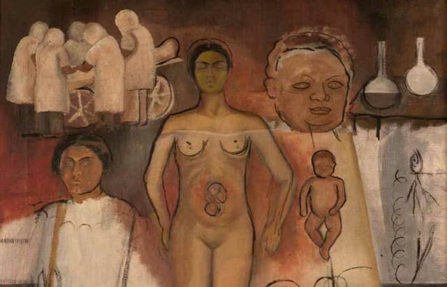 Frida and the cesarean section