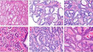Anatomía Patológica