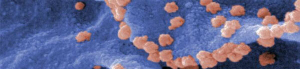 SARS (Sever Acute Raspatory Syndrome)