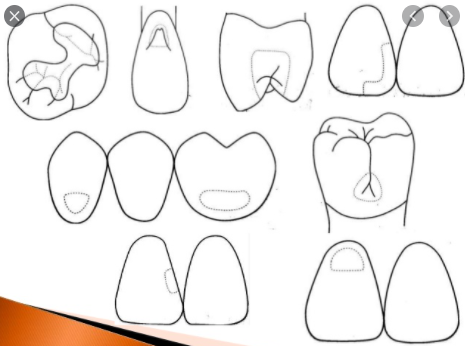 PREPARACIÓN CAVITARIA