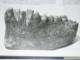 Incrustaciones de porcelana.