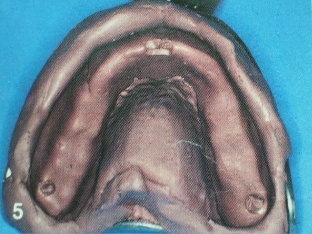 Materiales de impresión y poliéteres.