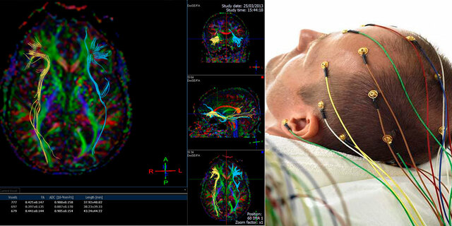 Inicios de electroencefalografía.