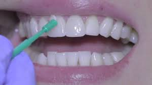 Flúor reconocido para prevenir caries dental hasta que el Dr Frederick MCKay descubre el moteado del esmalte