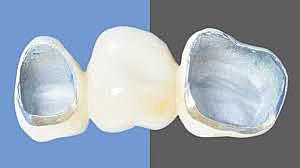 La cerámica moldeable (Dicor) fue desarrollada más tarde por Grossman en la fábrica de corning glass con baja resistencia a la flexión