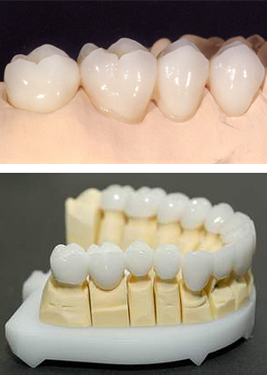 Se introdujo la Zirconia In-Ceram