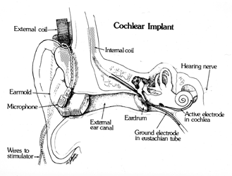A single channel cochlear implant, the 3M/House, was provided to children in clinical trials (ASHA, 2021).