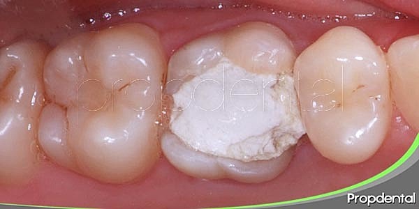 Gutapercha+óxido de zinc eugenol