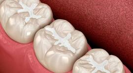 Timeline: Evolución de la Odontología Restauradora hasta la actualidad