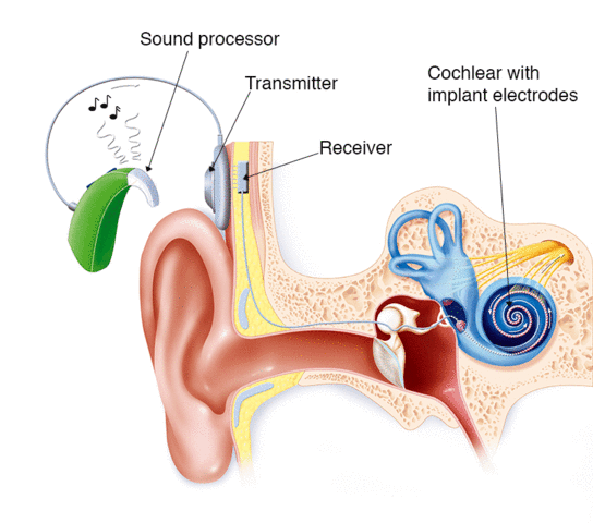 First Cochlear Implant was Implanted