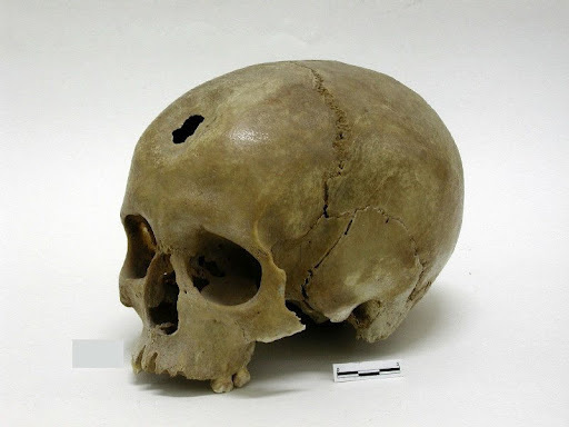 Trepanaciones