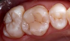 Restauración de dientes posteriores