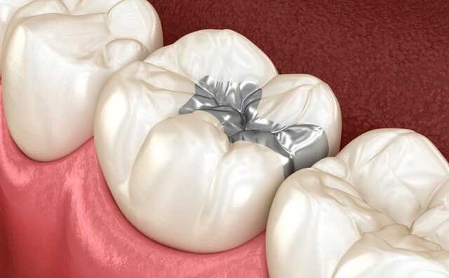 Comienzo de la amalgama dental