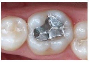 Se combinaron la plata y el mercurio. Tras este acontecimiento surge la amalgama