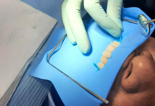 Se impulsó y creció la odontología quirúrgica tras el descubrimiento de el dique de goma.