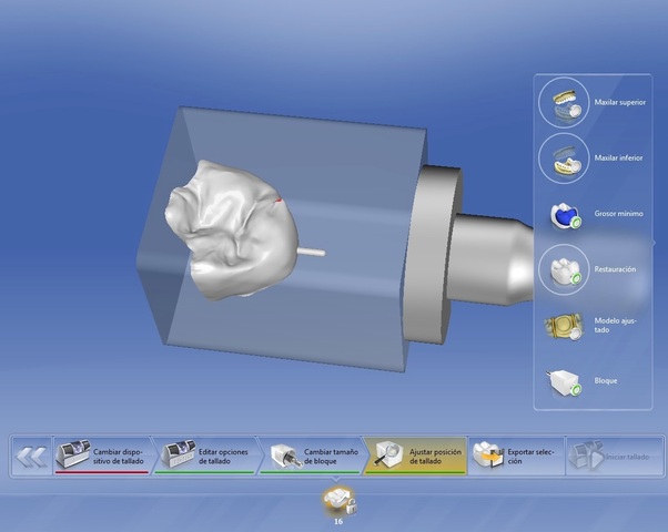 Incrustación de cerámica utilizando un dispositivo CAD / CAM