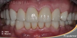 Restauraciones de cerámica