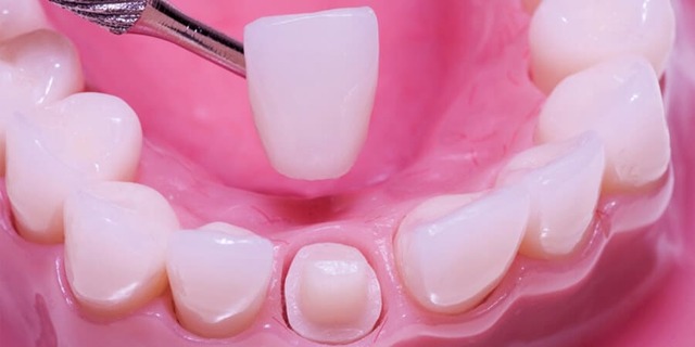 Zirconia In-Ceram