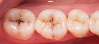 Fluoruros para prevenir las lesiones cariosas