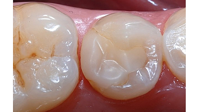 Resinas de metacrilato de metil