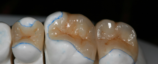 Incrustación de cerámica