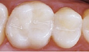 GIC condensable/autoendurecible