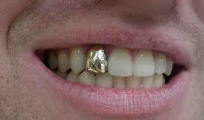 Primeras restauraciones dentales hechas con oro.