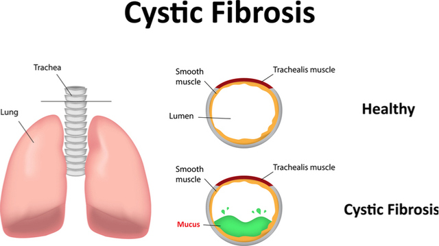 Cystic Fibrosis Gene