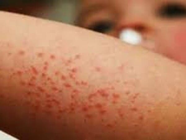 Modelo para explicar las epidemias del sarampión