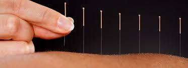 Acupuntura