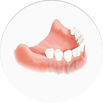 Implantes sin cirugia