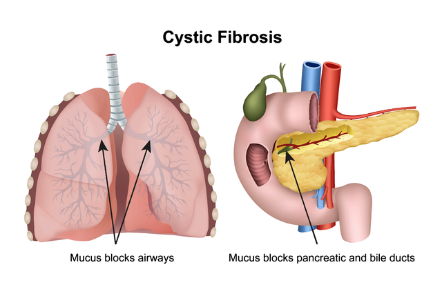 Cystic Fibrosis Gene