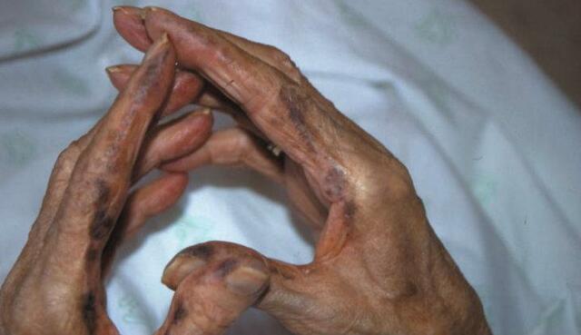 Enfermedad por genética