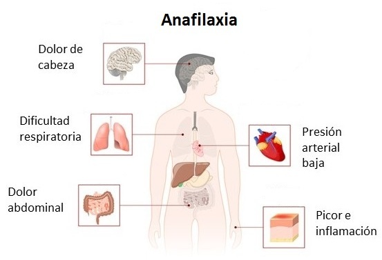 Anafilaxia sintomas