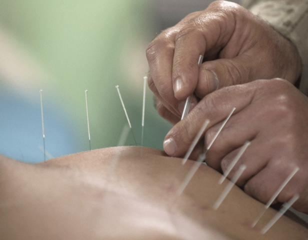 Acupuntura (2800 AC.)