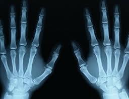 Rotgen descubre los rayos X