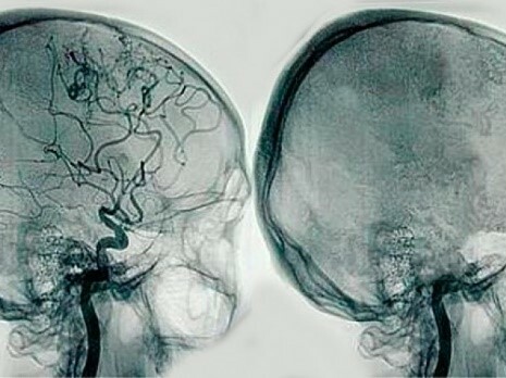 Segundo periodo de la neurocirugia (microcirugía y formación)