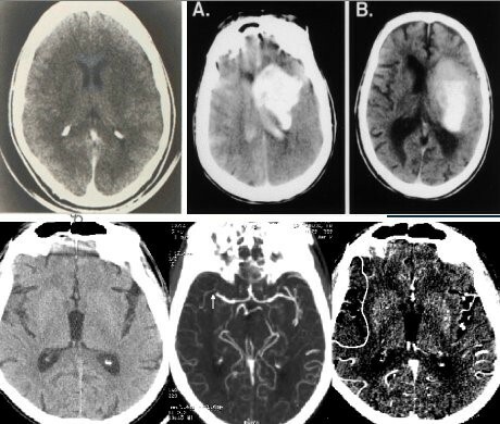 Tercer periodo de la neurocirugia (imagen diagnostica)