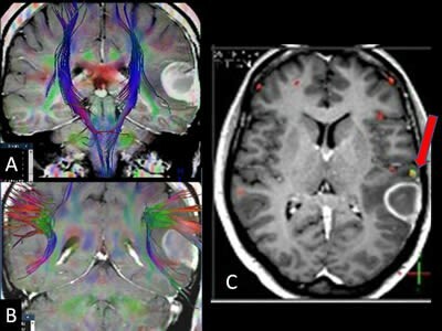 La tractografía por tensor de difusión (DTI)
